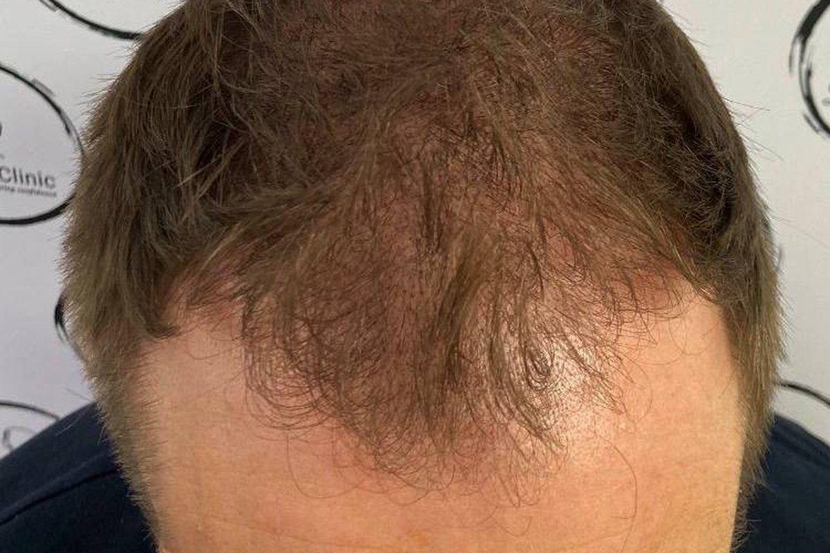 After scalp micropigmentation, full, natural hairline