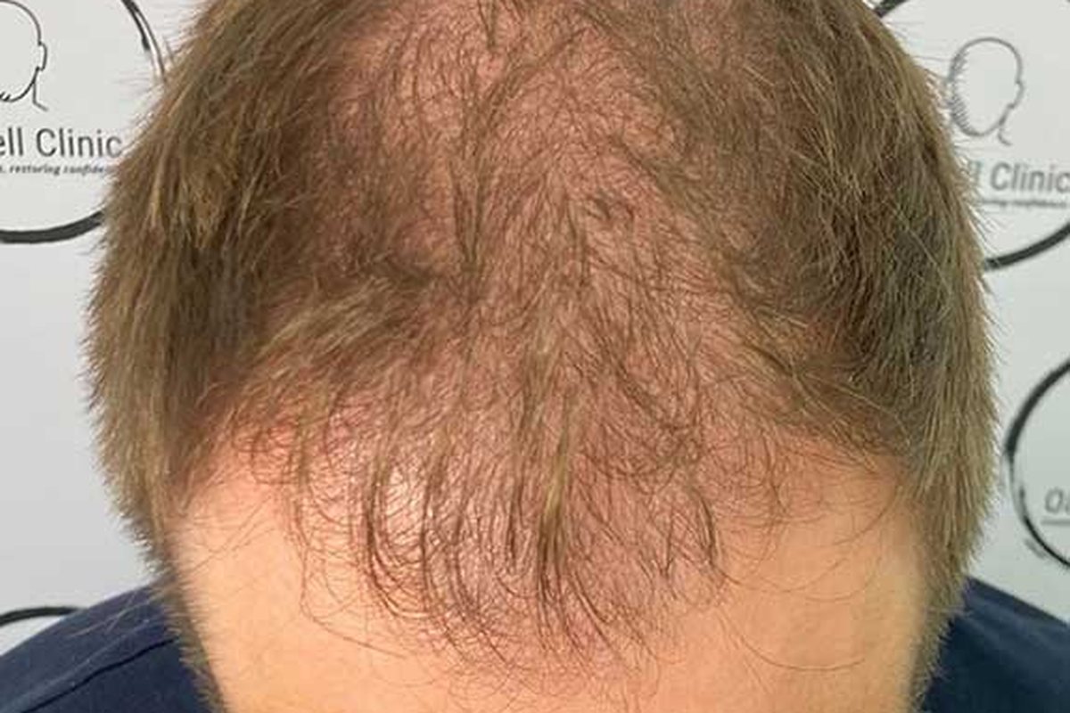 Before scalp micropigmentation, receding, thinning hairline