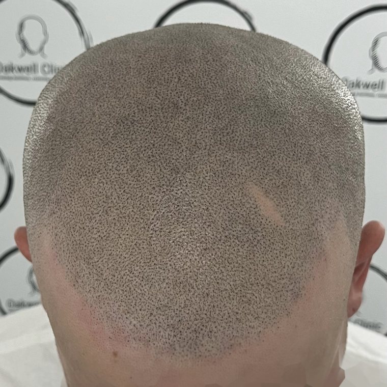 Scalp micropigmentation result 1, Full SMP at Oakwell Clinic Leeds