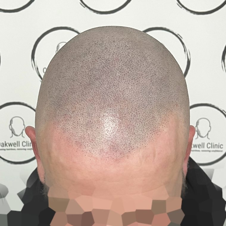 Scalp micropigmentation result 2, Hairline at Oakwell Clinic Leeds
