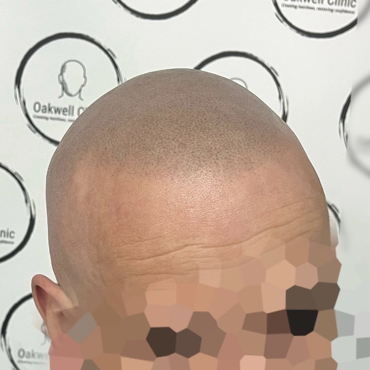 Scalp micropigmentation result 3, Density at Oakwell Clinic Leeds
