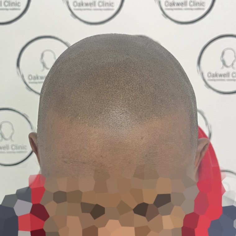 Scalp micropigmentation result 4, Scar camouflage at Oakwell Clinic Leeds