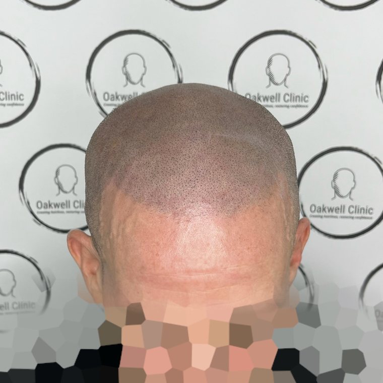 Scalp micropigmentation result 5, Full SMP at Oakwell Clinic Leeds