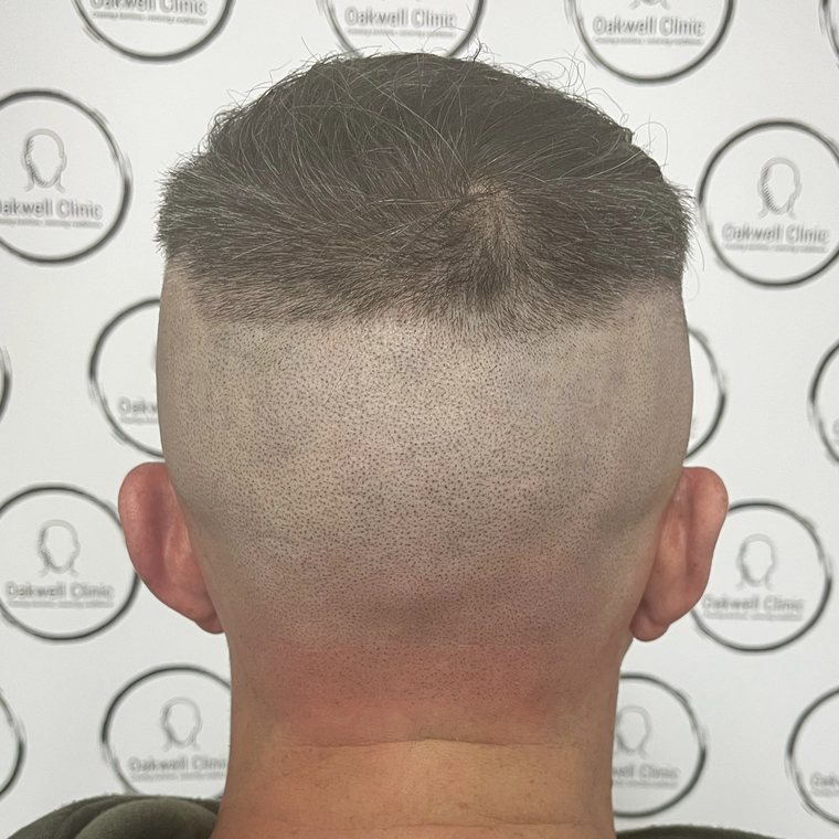 Scalp micropigmentation result 6, Alopecia at Oakwell Clinic Leeds