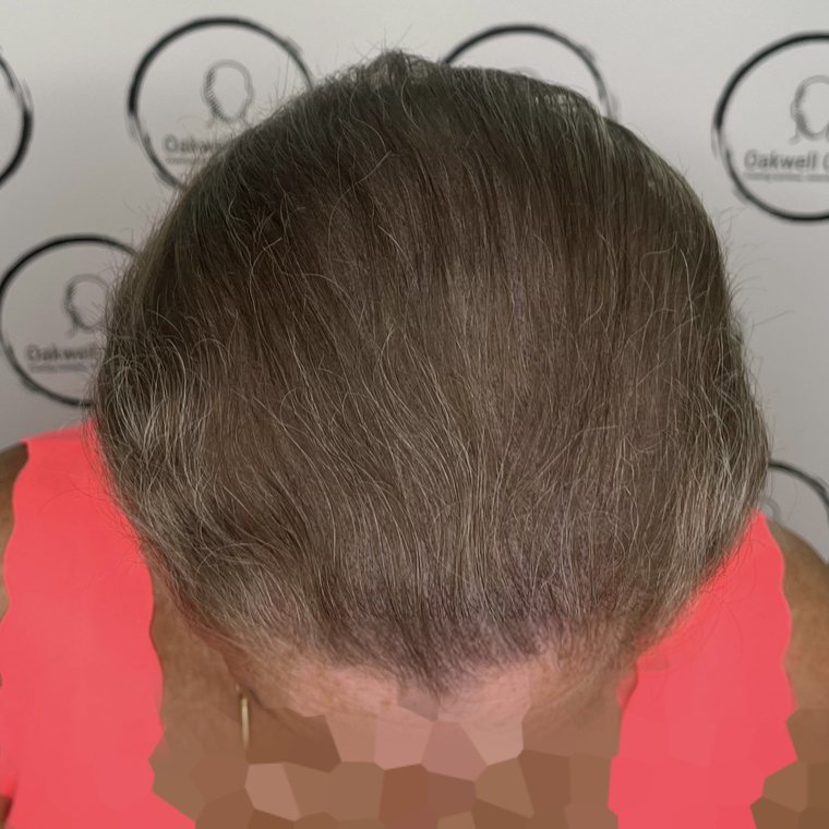 Scalp micropigmentation result 7, Hairline at Oakwell Clinic Leeds