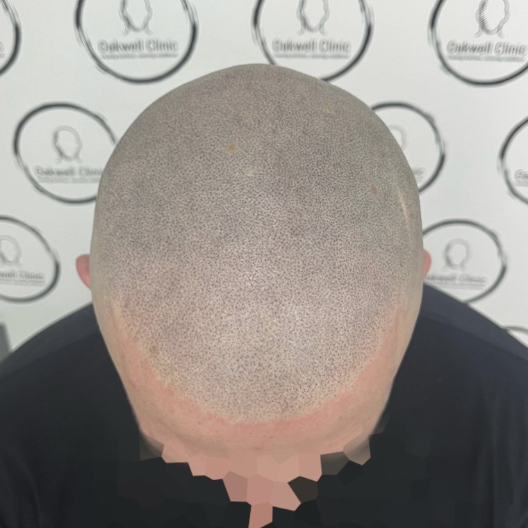 Scalp micropigmentation result 8, Density at Oakwell Clinic Leeds
