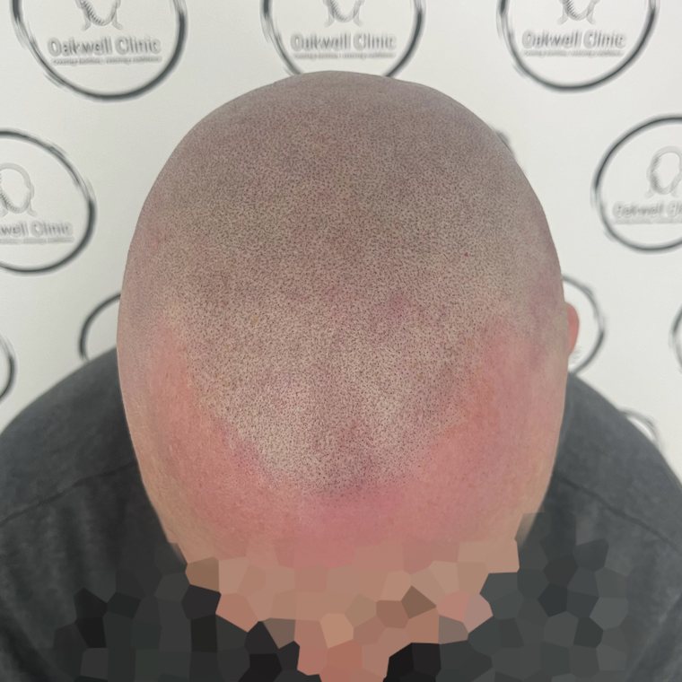Scalp micropigmentation result 9, Women's SMP at Oakwell Clinic Leeds