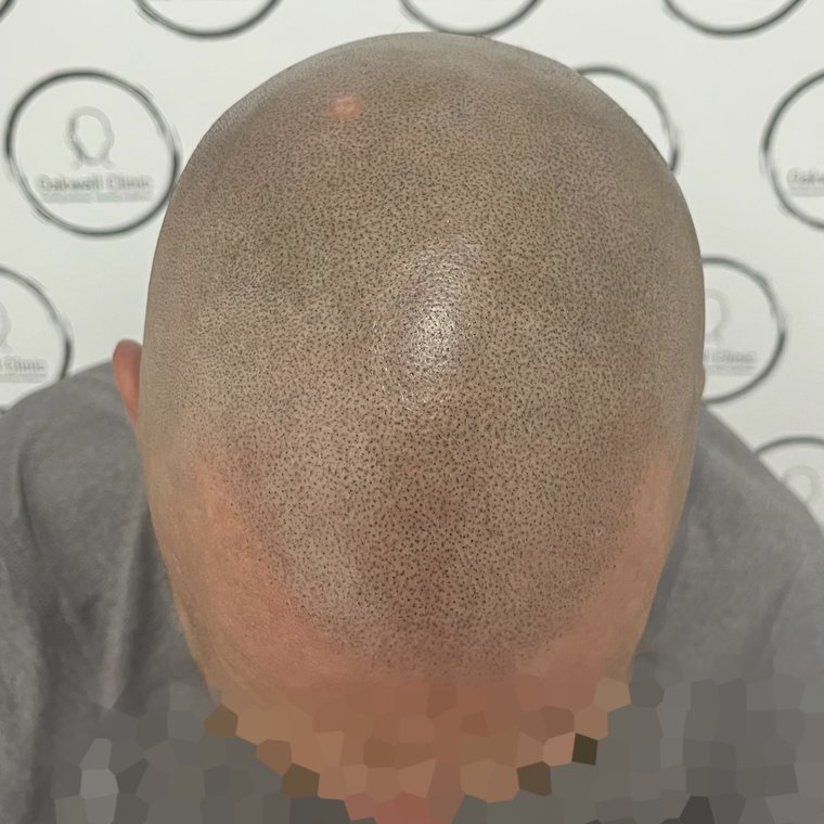 Scalp micropigmentation result 10, Full SMP at Oakwell Clinic Leeds