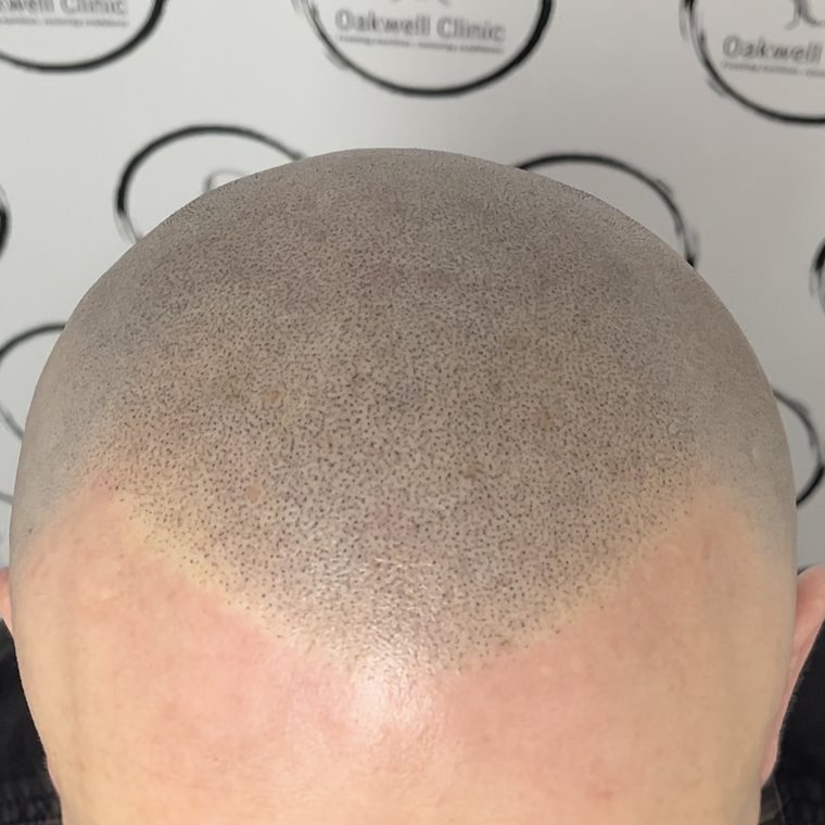 Scalp micropigmentation result 11, Scar camouflage at Oakwell Clinic Leeds