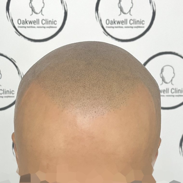 Scalp micropigmentation result 12, Hairline at Oakwell Clinic Leeds