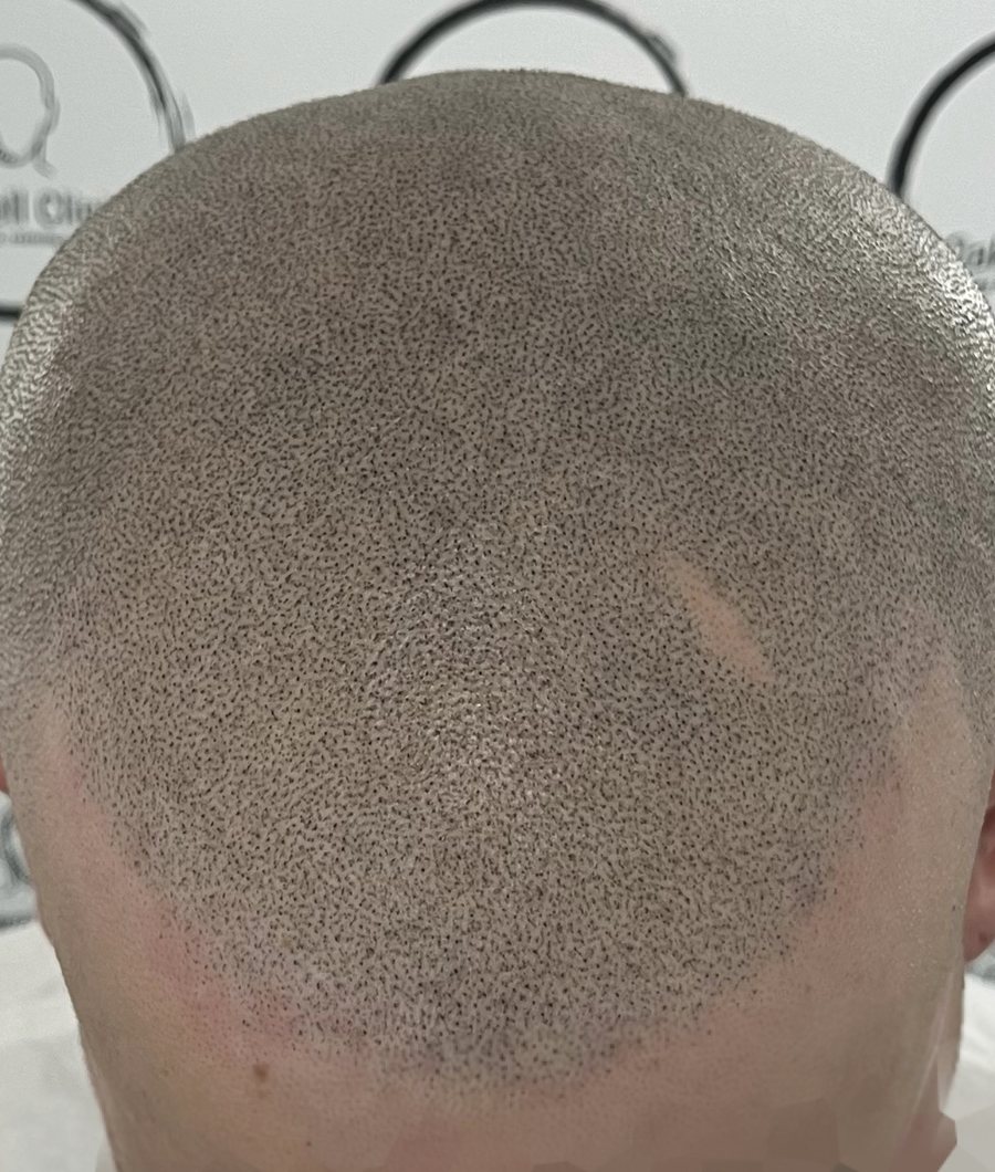Natural scalp micropigmentation result by Oakwell SMP Clinic, Leeds