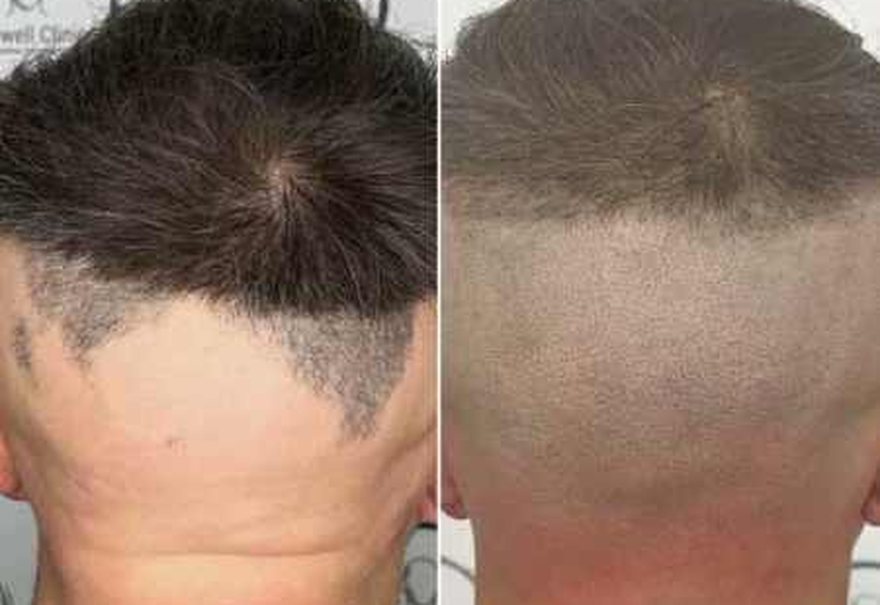 Alopecia treatment with scalp micropigmentation