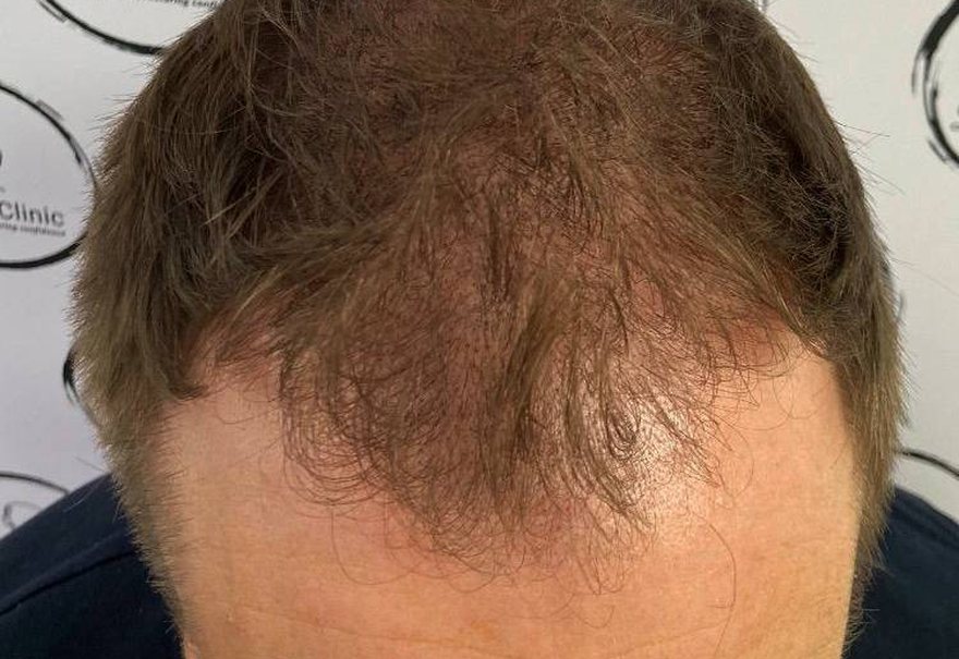 Added density through thinning hair with SMP