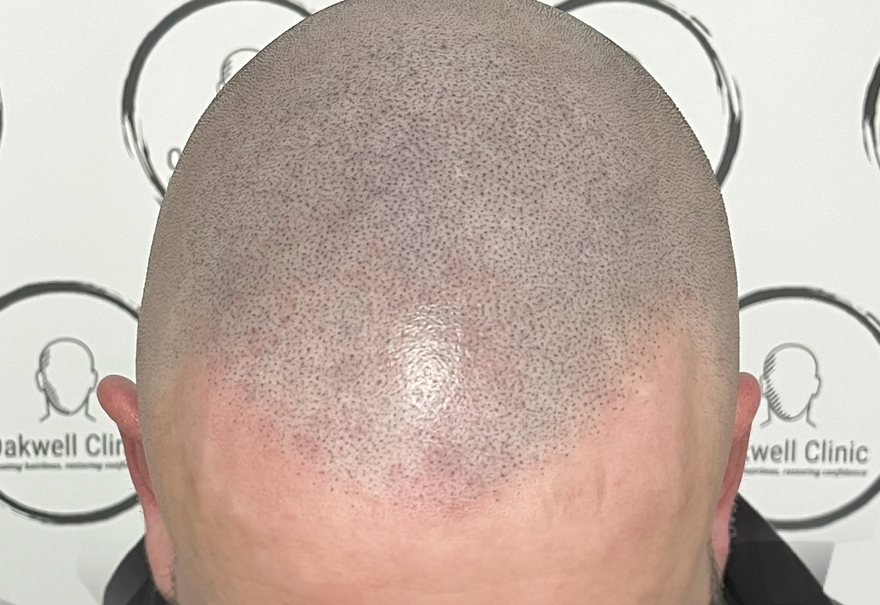 Full scalp micropigmentation buzz-cut look