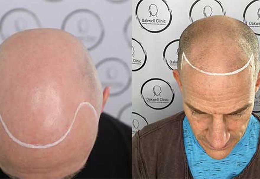 Restored natural hairline with SMP