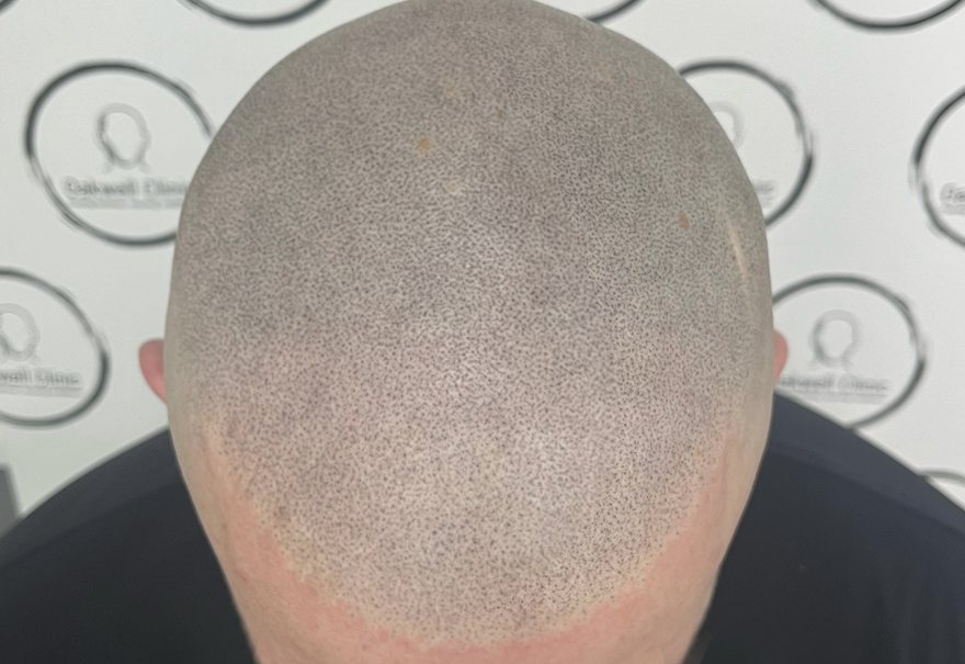 Hair transplant scar camouflage with SMP