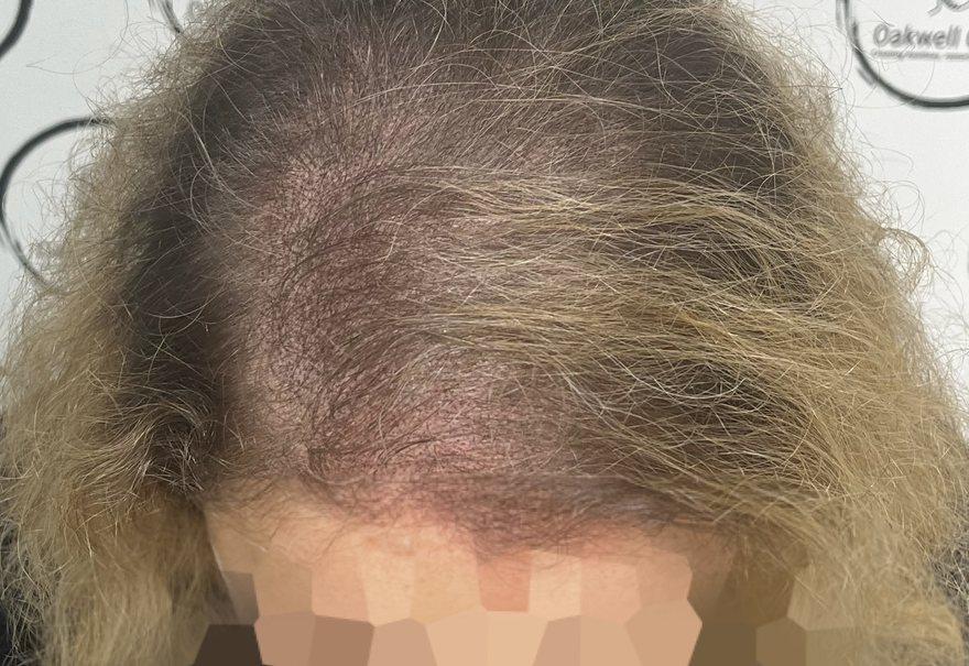 Women's hair density SMP treatment